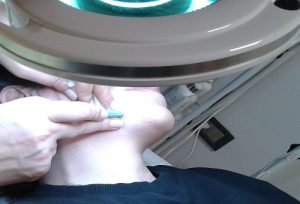 igneli-epilasyon-300x204