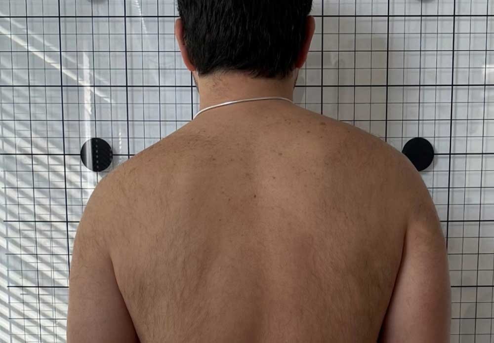 Skolyoz-Da-Duzeltici-Egzersiz