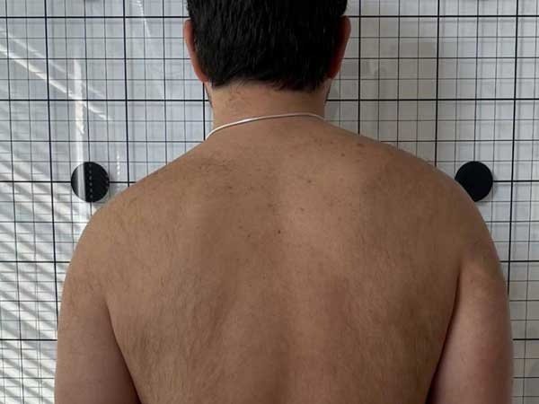 Skolyozda-Duzeltici-Egzersiz-Icon