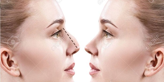 Estetik Burun Ameliyatı