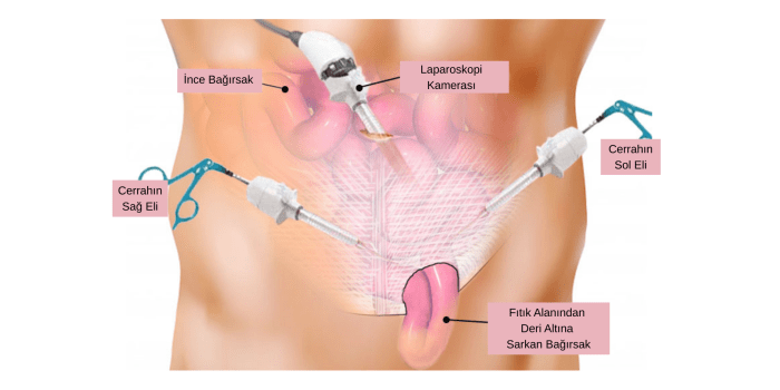 Laparoskopik Fıtık Ameliyatı Tekniği Hakkında