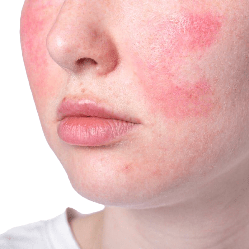 Rosacea