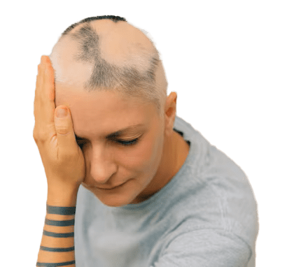 Alopesi-Areata