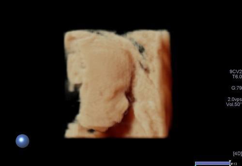 obstrerik-ultrasonu-1