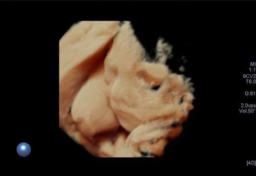 obstrerik-ultrasonu-3