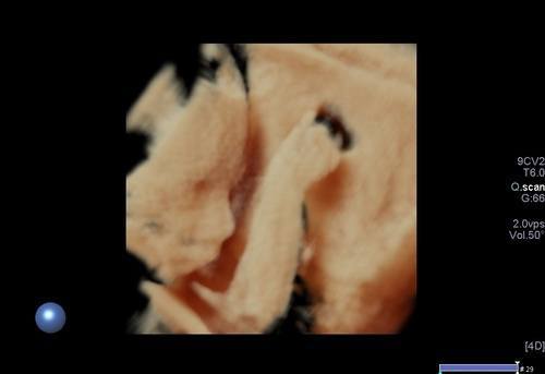 obstrerik-ultrasonu-2