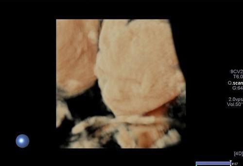 OBSTETRİK ULTRASONU