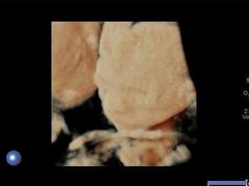 OBSTETRİK ULTRASONU