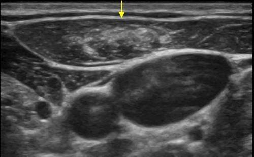 YÜZEYSEL ULTRASON İNCELEMESİ