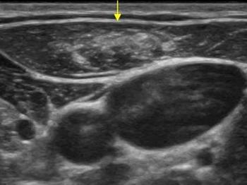 YÜZEYSEL ULTRASON İNCELEMESİ