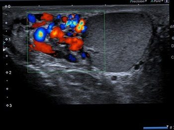 SKROTAL TESTİS ULTRASONU