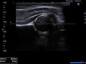 PEDİATRİK KALÇA ULTRASONU