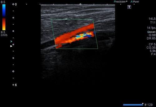 Ekstremite-Arter-Renkli-Doppler-Ultrason-2