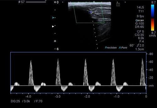 Ekstremite-Arter-Renkli-Doppler-Ultrason-1