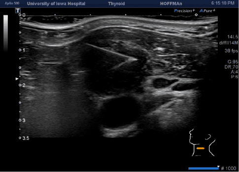 Lenf Nodu İnce İğne Aspirasyon Biyopsisi