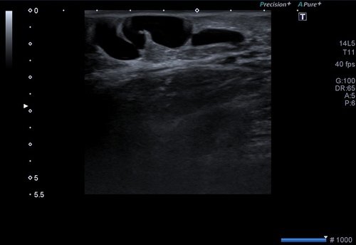 Ekstremite-Venöz-Doppler-Ultrason-2