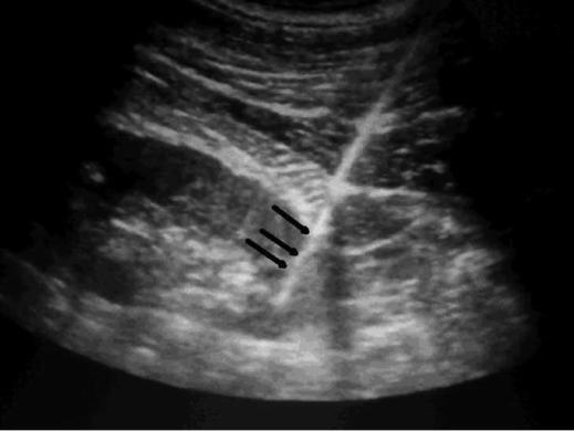 Bobrek Tru-Cut (Kalın İğne) Biyopsisi