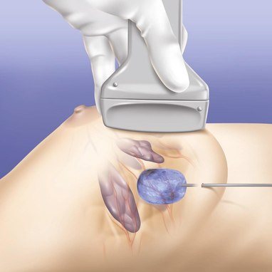 Meme Fibroadenomlarında Radyofrekans Ablasyon