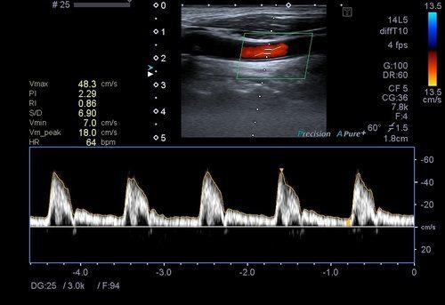 Karotis-Vertebral-Arter-Renkli-Doppler-Ultrason