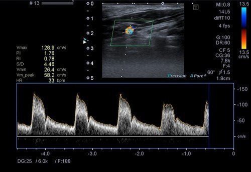 Karotis-Vertebral-Arter-Renkli-Doppler-Ultrason-2