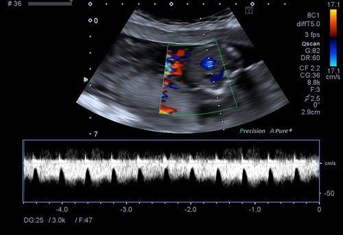 Obstetrik-(Gebelik)-Renkli-Doppler-Ultrason