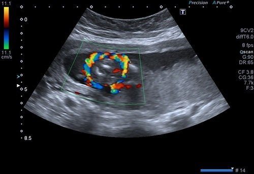 Obstetrik-(Gebelik)-Renkli-Doppler-Ultrason-2