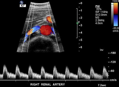 Renal Arter Renkli Doppler Ultrason 2