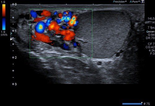 Skrotal-(TESTİS)-Renkli-Doppler-Ultrason