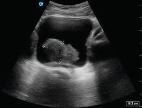 Renal Ve Üriner Sistem Ultrasonu