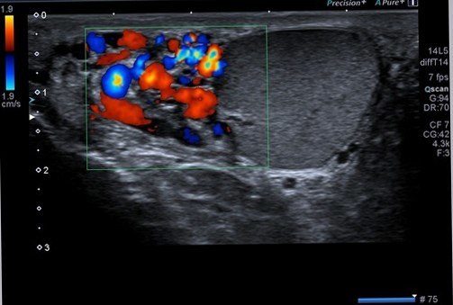 Skrotal-Testis-Ultrasonu