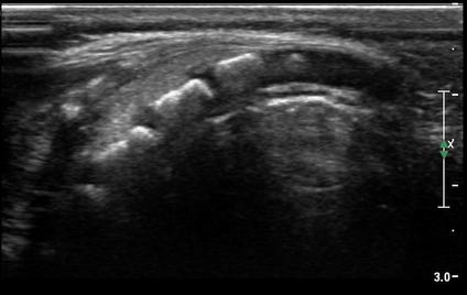 PEDİATRİK SAKRAL ULTRASON 1