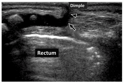 PEDİATRİK SAKRAL ULTRASON 2