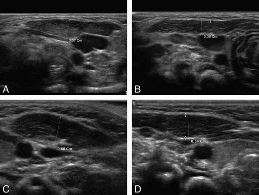 Pediatrik Boyun Ultrasonu