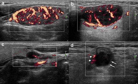 Pediatrik Boyun Ultrasonu 2