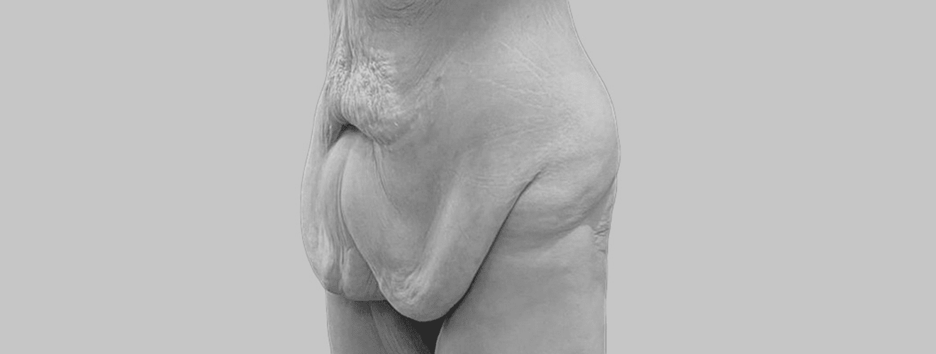 Après la chirurgie bariatrique