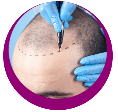 GREFFE DE CHEVEUX FUE