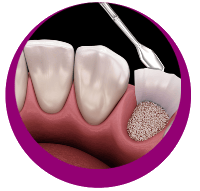 AUGMENTATION OSSEUSE