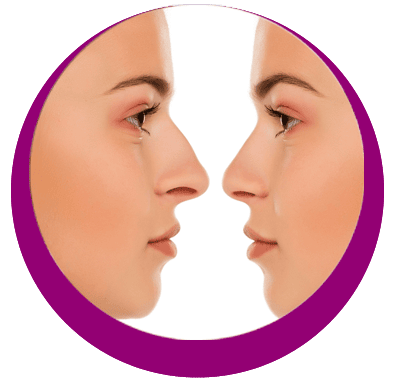 RHINOPLASTIE
