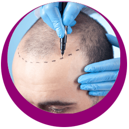 FUE-HAARTRANSPLANTATION