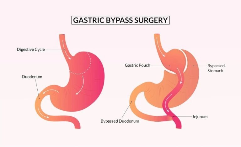Cirugía-De-Bypass-Gástrico-En-Turquía