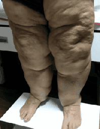 Lipödem Görünümü 3