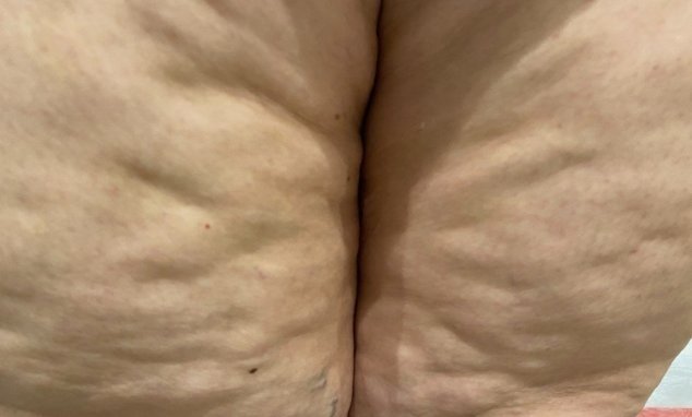 Bacaklarda Dalgalı Görünüm