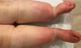 Lipödem Görünümü 1