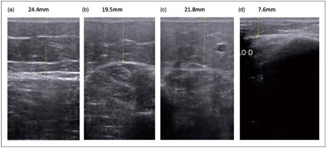 Lipödem Ultrasonda Görünüm