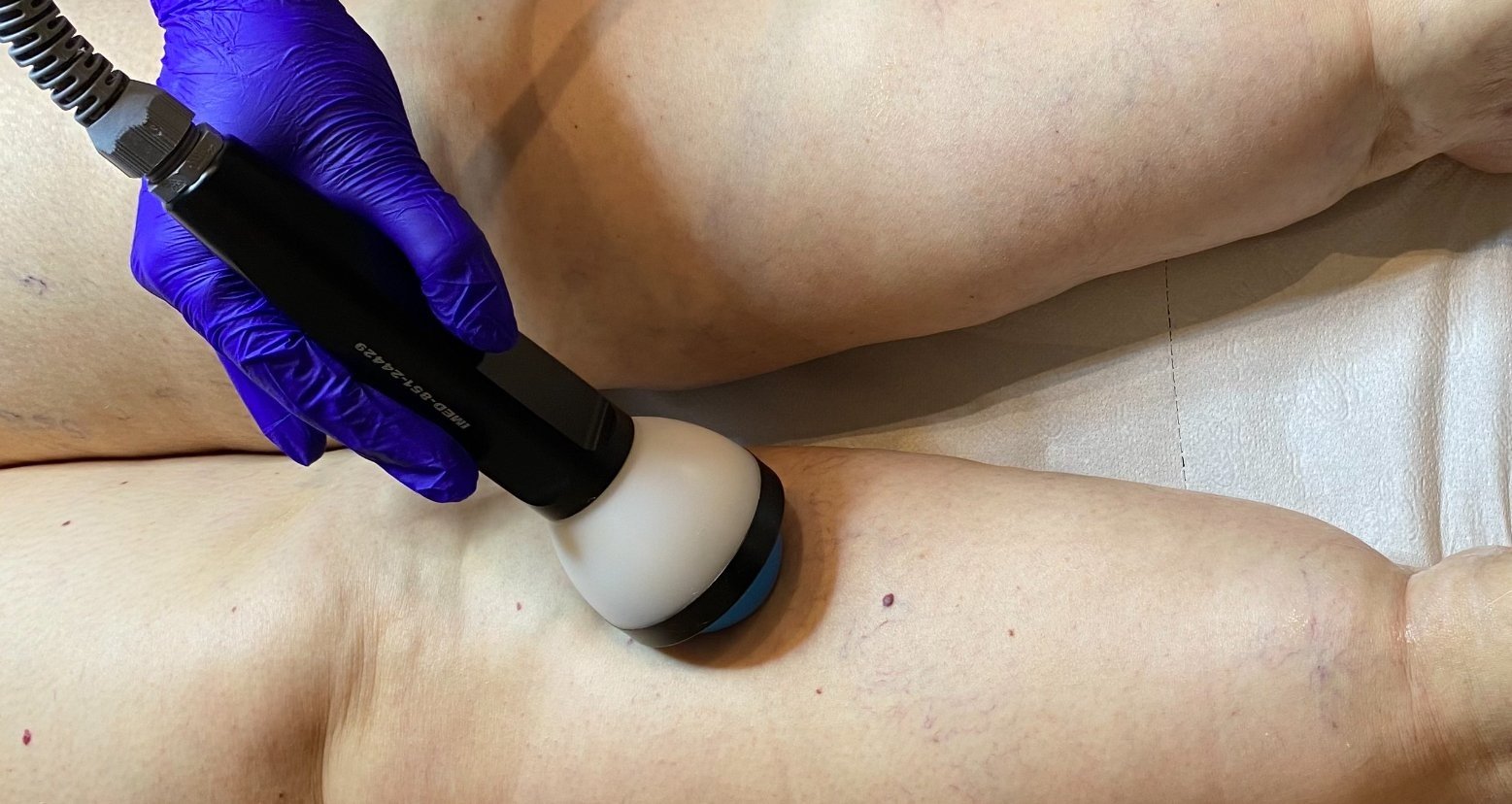 Lipödem Için Modus Focused Eswt Cihazı Uygulaması