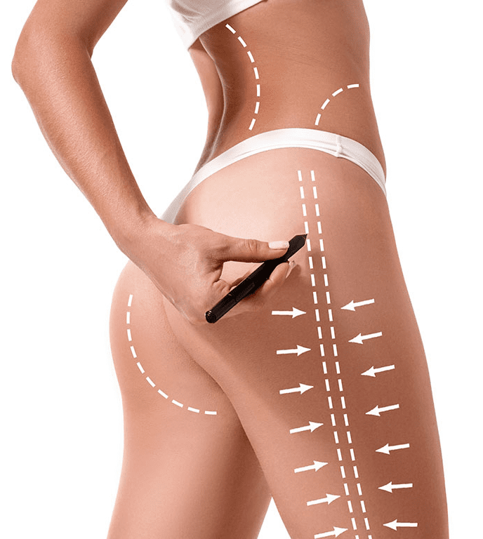 Lipoliz-Nedir,-Nasıl-Uygulanır-2