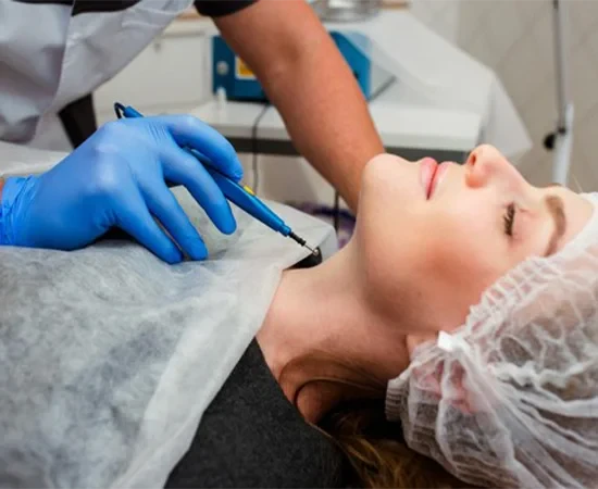 Elektrokoterizasyon-Ile-Sigil-Tedavisi