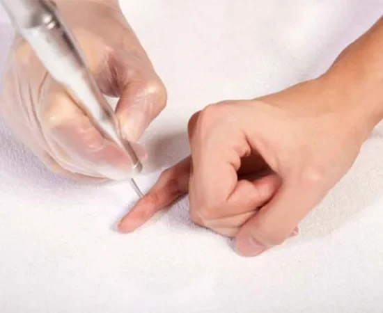 Lazer-Ile-Sigil-Tedavisi