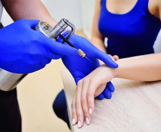 Kriyoterapi-Ile-Sigil-Tedavisi