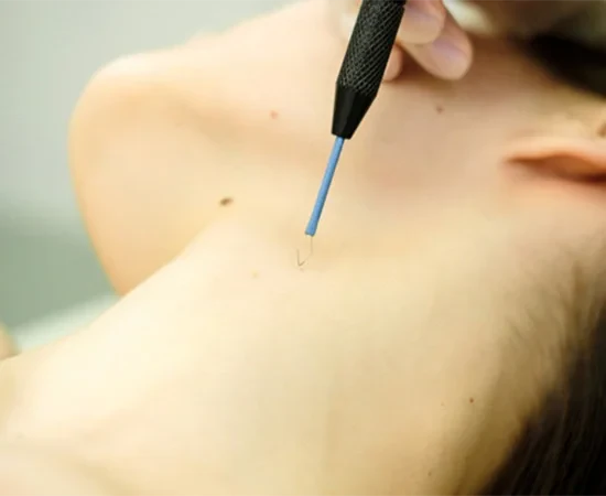 Radyofrekans-Ile-Sigil-Tedavisi